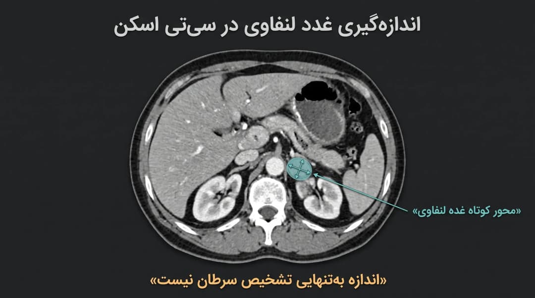 غدد لنفاوی شکم