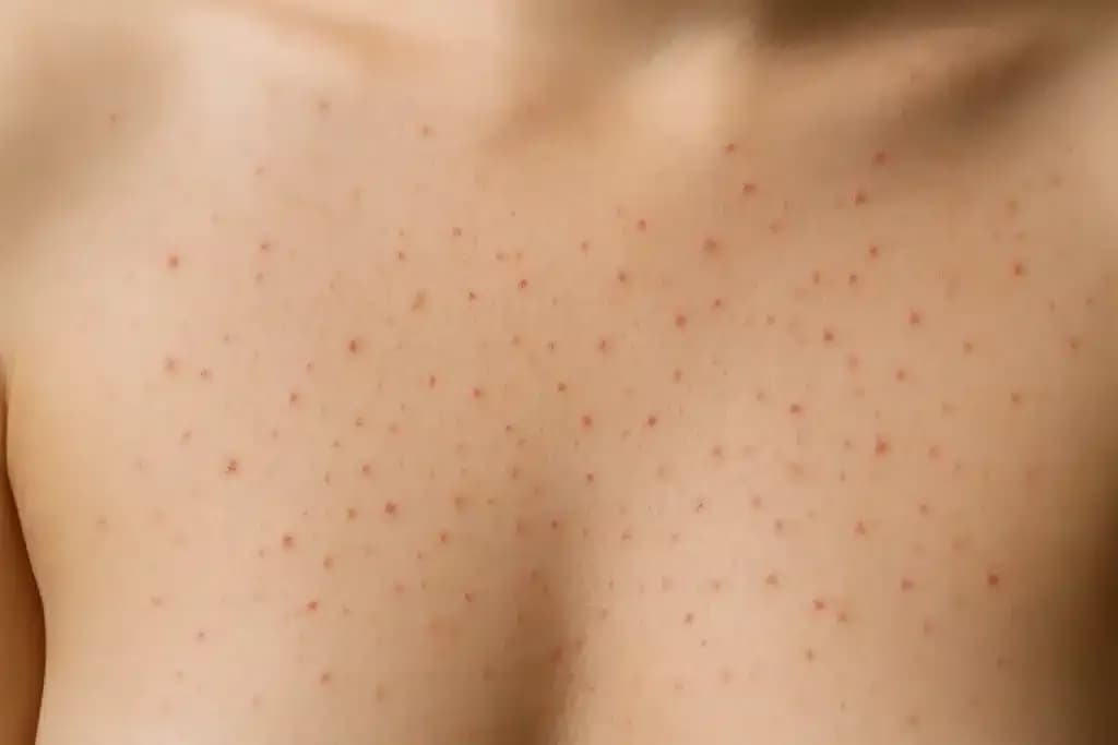 acne-symptoms-of-breast-cancer-in-women.3-1024x683.webp