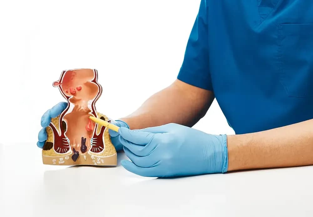anal-cancer.webp
