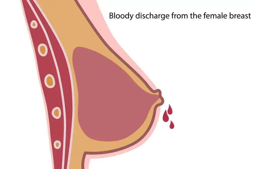 bloody-breast-discharge.webp