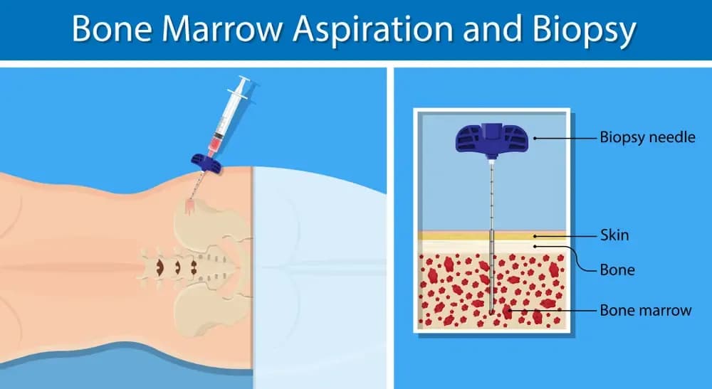 bone-biopsy.3.webp