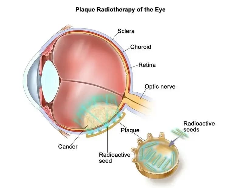 brachytherapy.1.webp