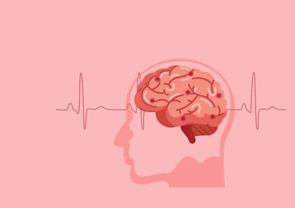 brain-stroke-and-heart-attack-in-cancer-patients.2.webp