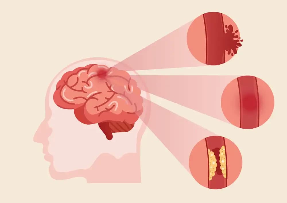 brain-stroke.2.webp