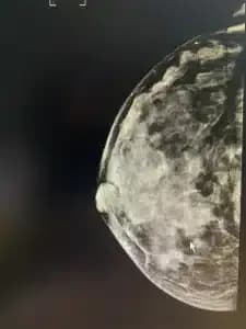 breast-calcification.1-225x300.webp