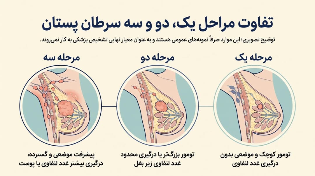 شناخت مراحل سرطان پستان