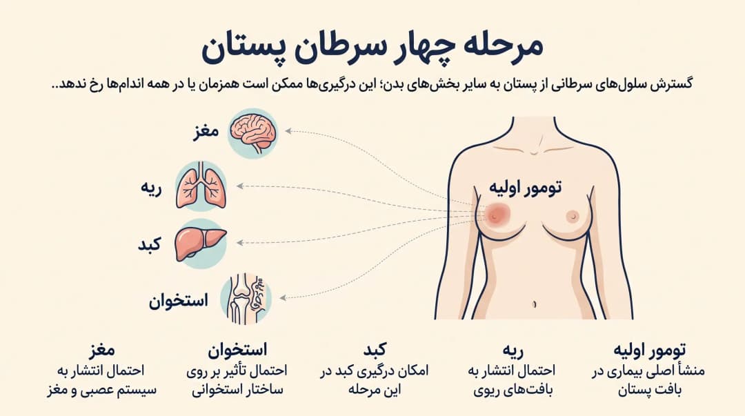 شناخت مراحل سرطان پستان