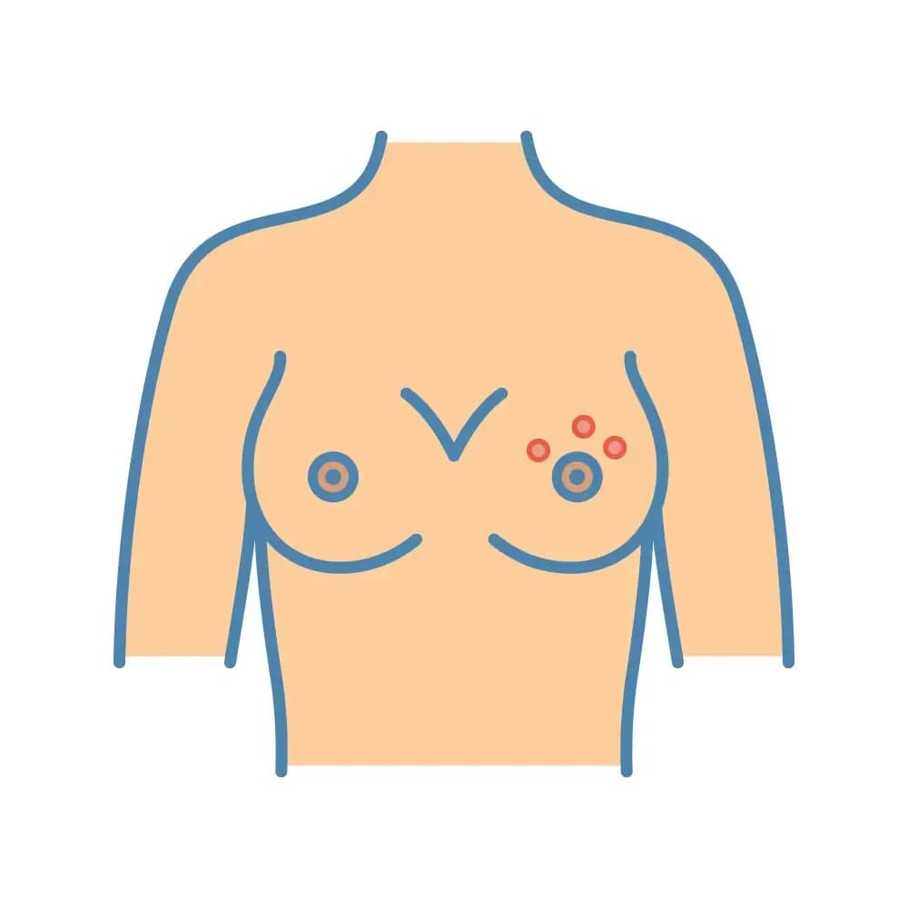 breast-fungus.1.webp