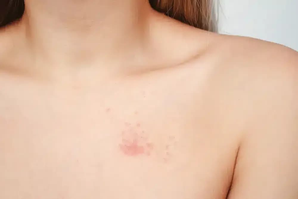 breast-fungus.webp