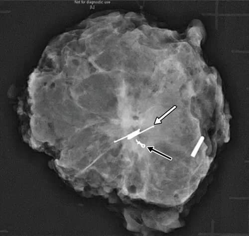 breast-implants.1.webp