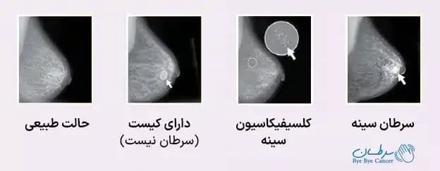 breast-lump-picutres-f26eb6-copy.webp