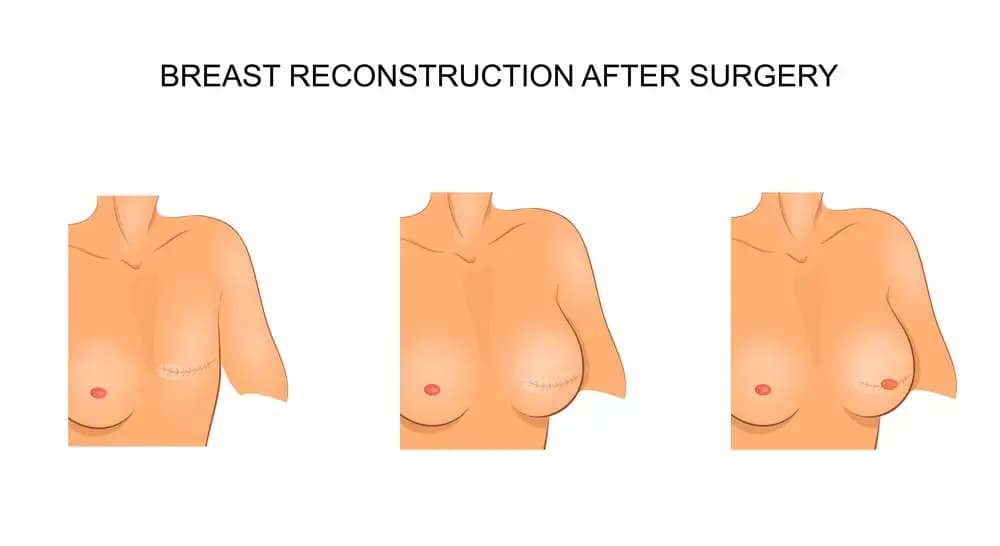 breast-tissue-reconstruction.webp
