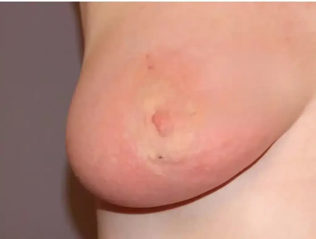 breastcancer1-1024x776.webp