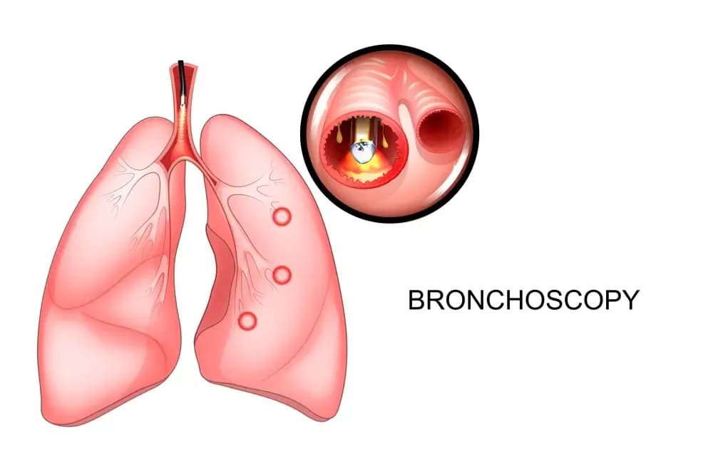 bronchoscopy.webp