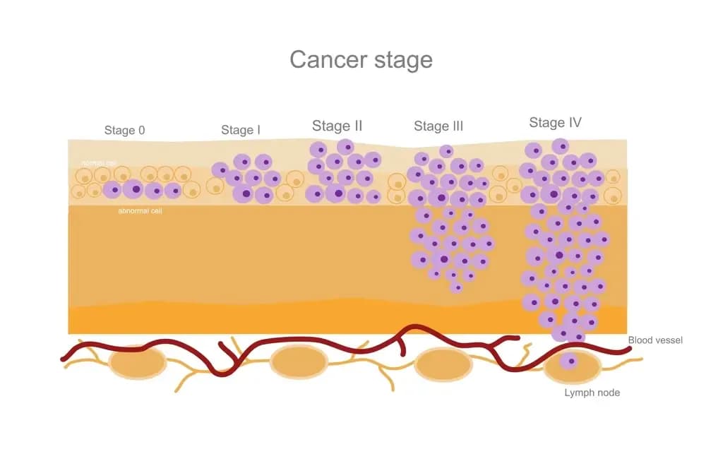cancer-grade.1.webp
