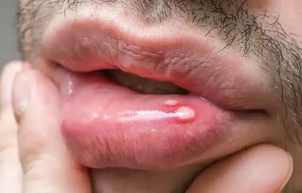 canker-sores.1.webp