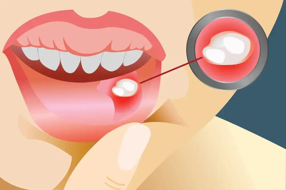 canker-sores.2.webp