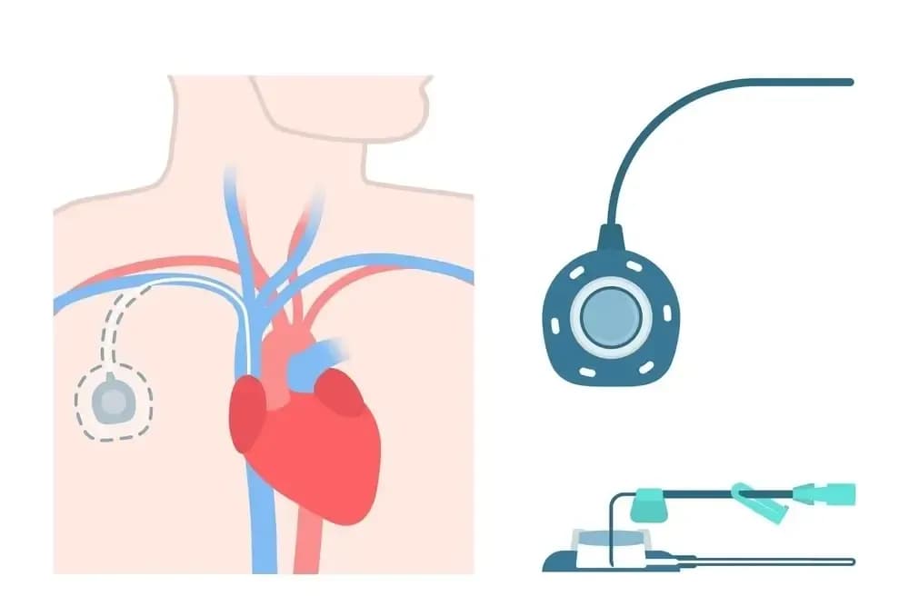 chemotherapy-port.1.webp