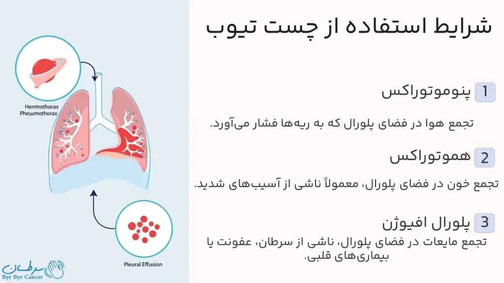 chest-tube.2-1024x576.webp