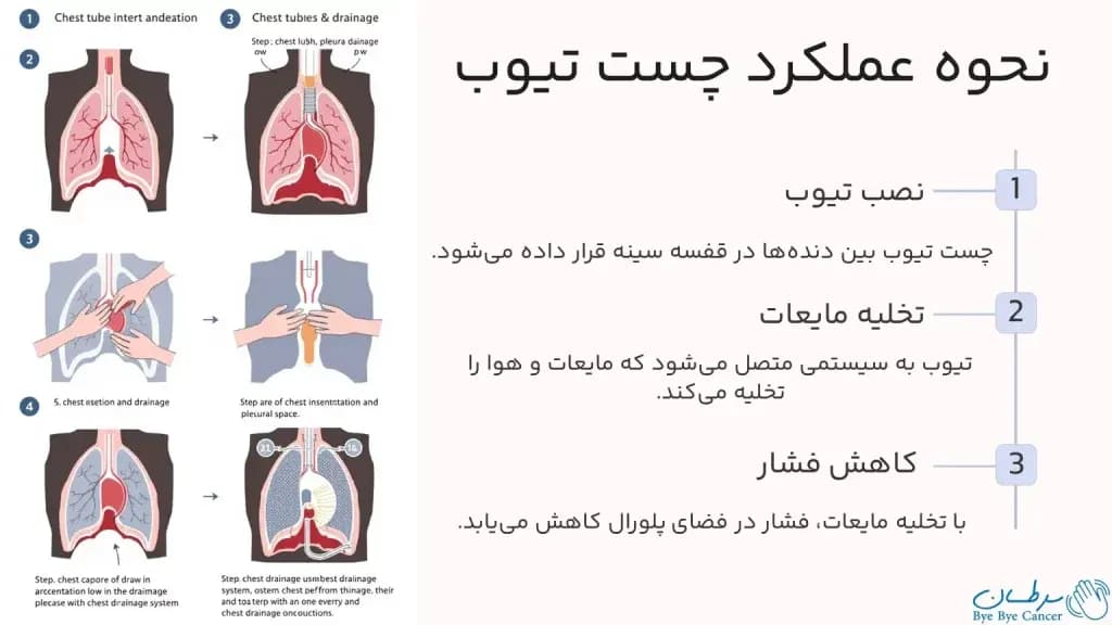 chest-tube.3-1024x576.webp