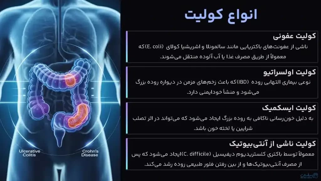 colitis.1-1024x576.webp