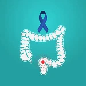 colon-cancer-danger-sign.1-1-300x300.webp