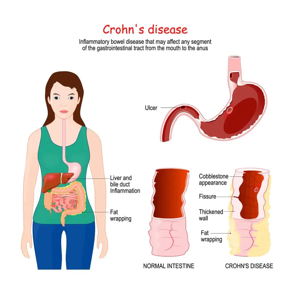 crohns-disease.2.webp