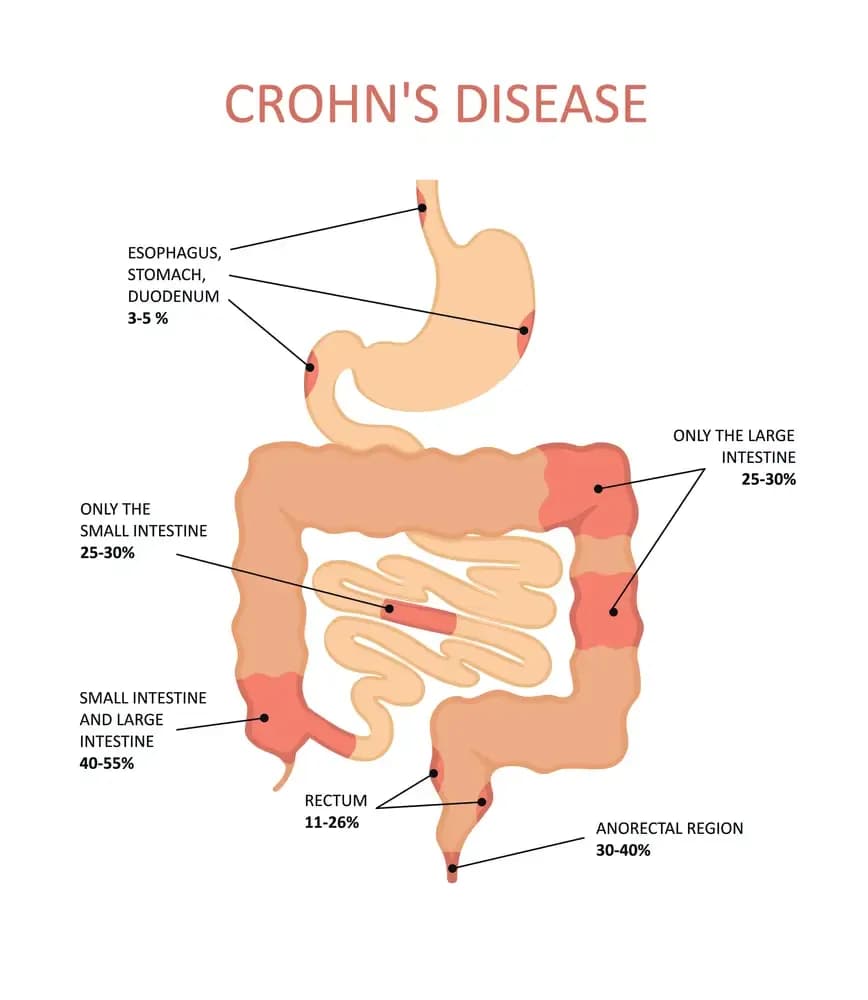 crohns-disease.3.webp