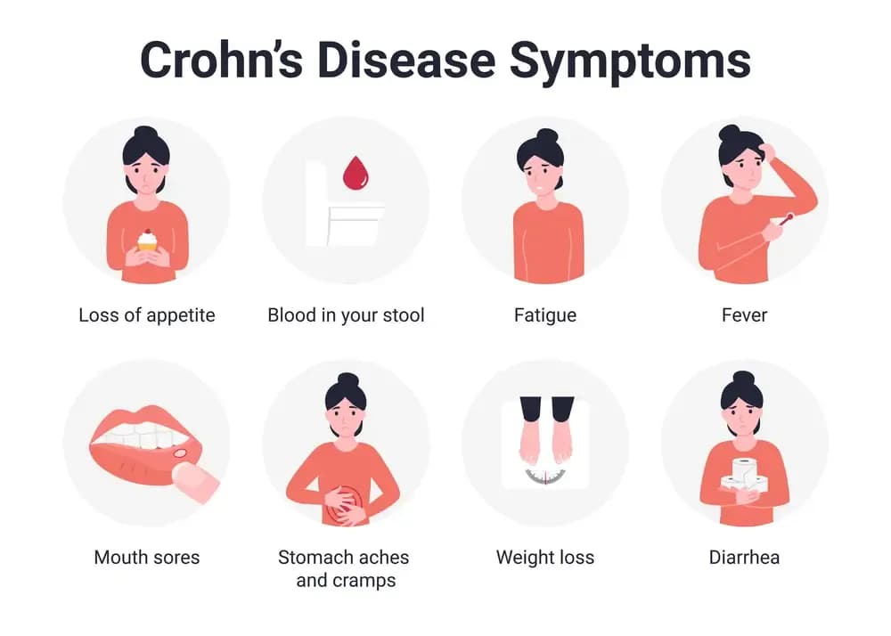 crohns-disease.4.webp