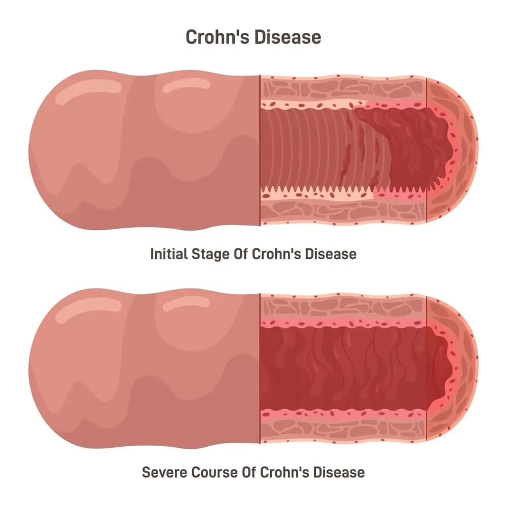 crohns-disease.5.webp