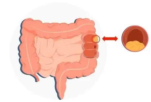 dangerous-symptoms-of-colon-cancer.webp