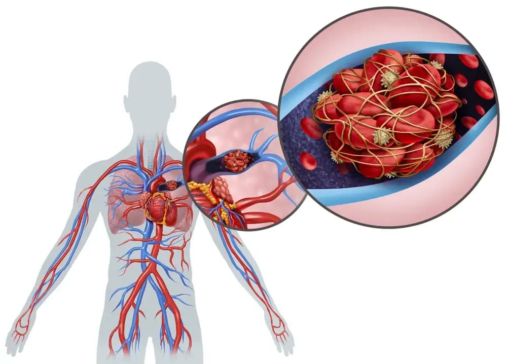 embolism.1.webp