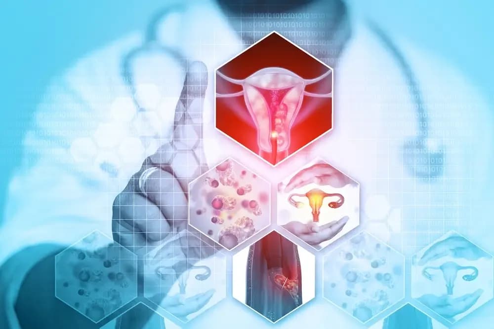 endometrial-cancer.1.webp