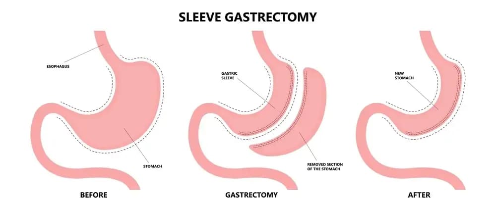 gastrectomy-surgery.webp
