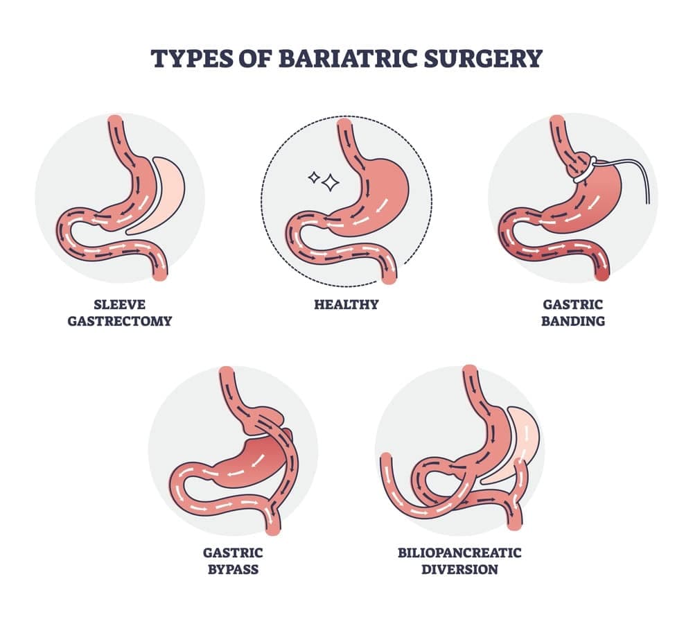 gastrectomy.1.jpg