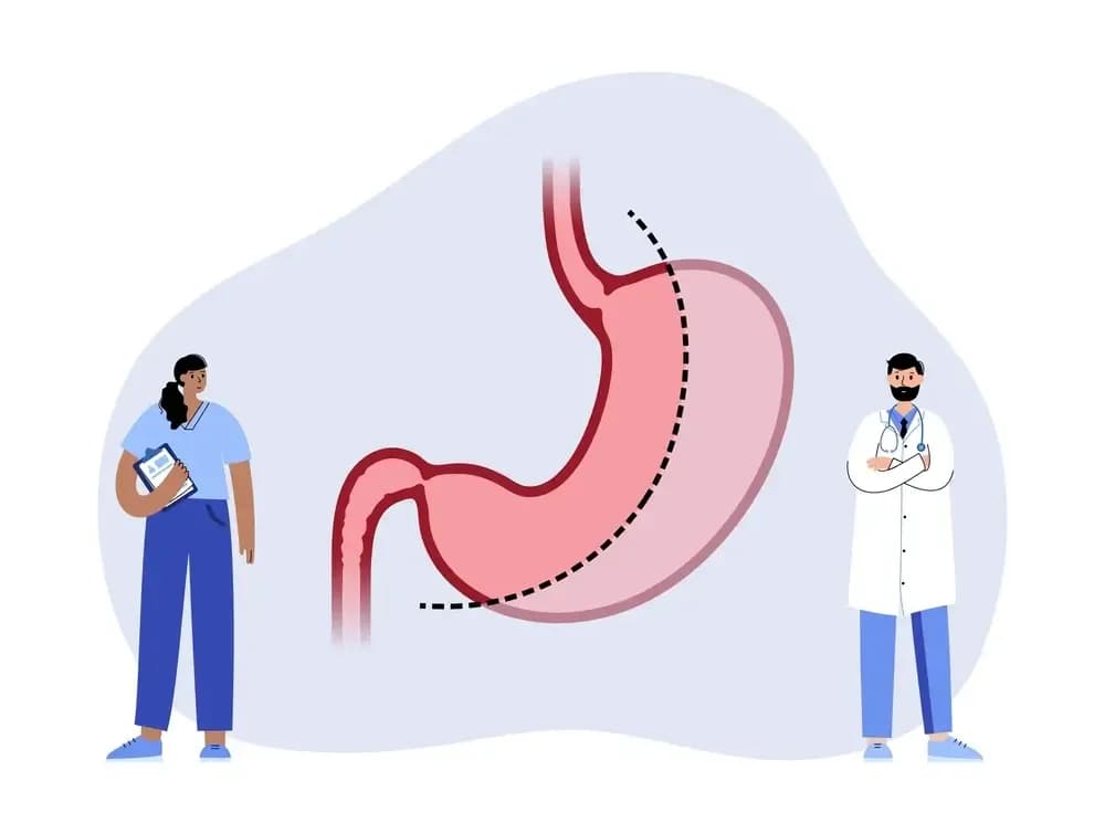 gastrectomy.2.webp