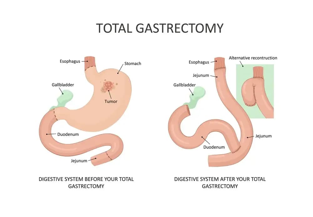 gastrectomy.3.webp