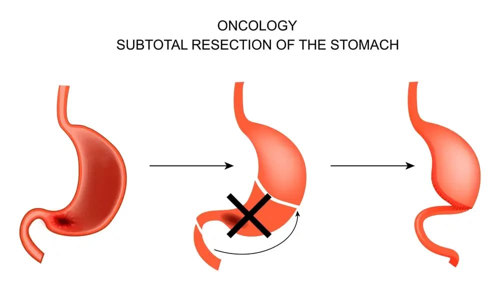 gastric-surgery.1.webp