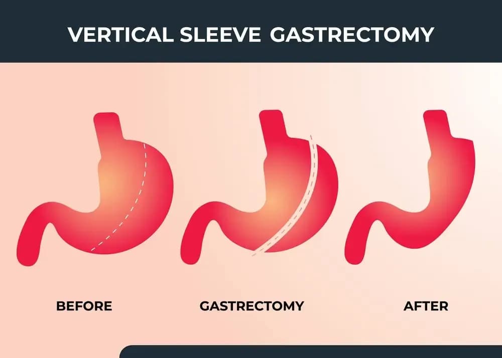gastric-surgery.webp