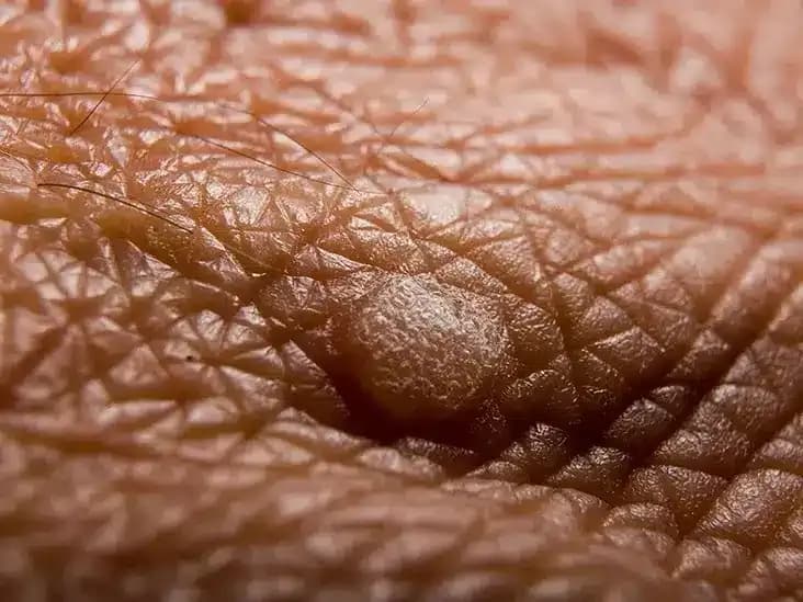 genital-warts.webp