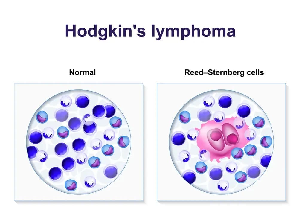 hodgkins-lymphoma.2.webp