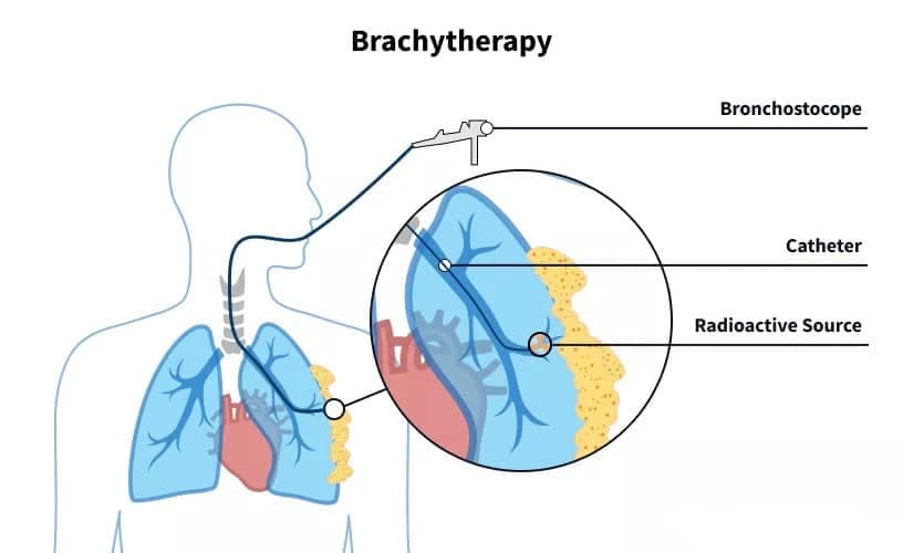 internal-radiation-therapy.jpg