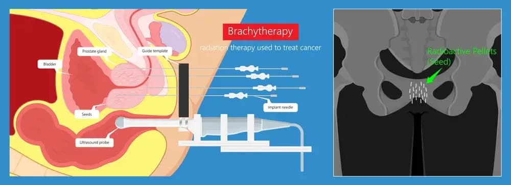 internal-radiotherapy.webp