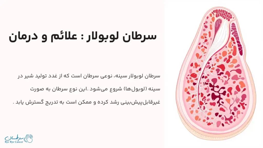lobular-cancer.1-1024x576.webp
