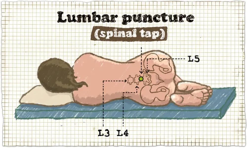 lumbar-puncture.1.webp