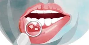 mucositis-300x152.webp