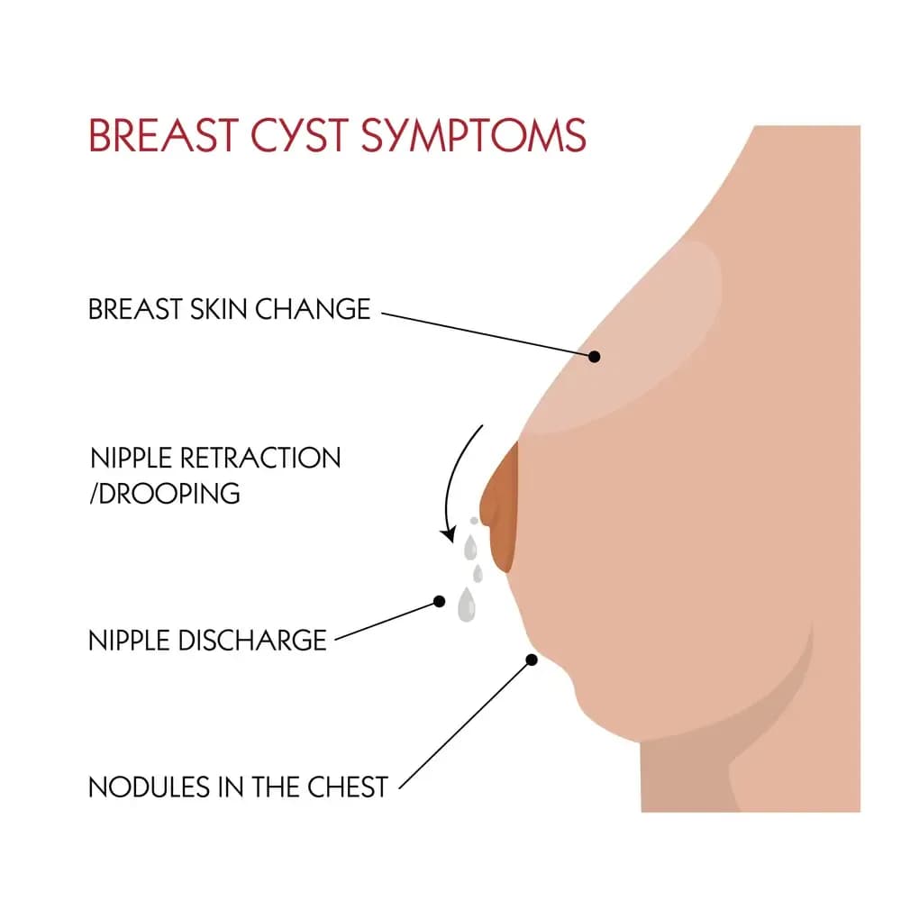 nipple-discharge.webp