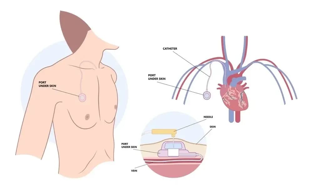 operation-of-chemotherapy-port.webp