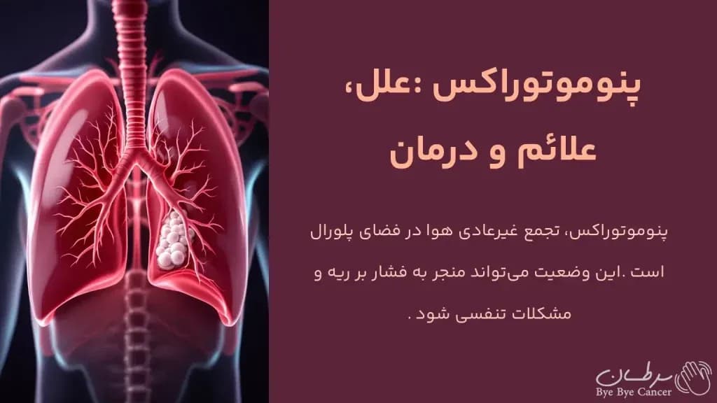pneumothorax.1-1024x576.webp