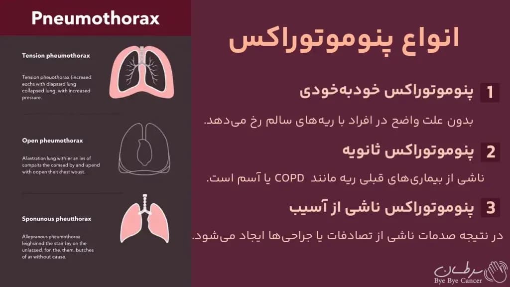 pneumothorax.2-1024x576.webp